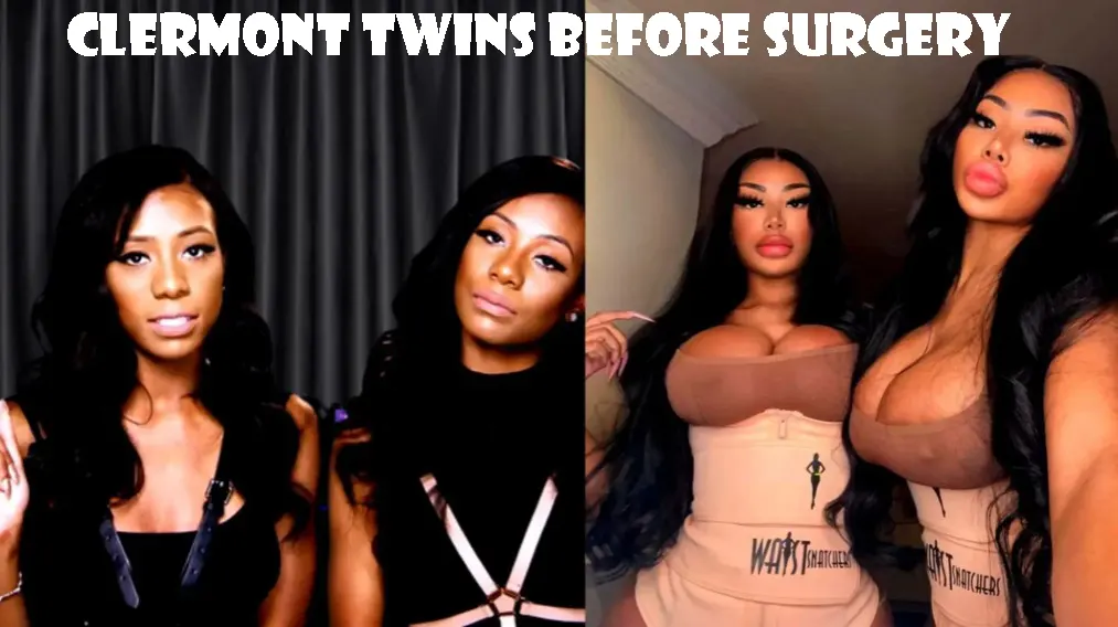 Clermont Twins Before Surgery